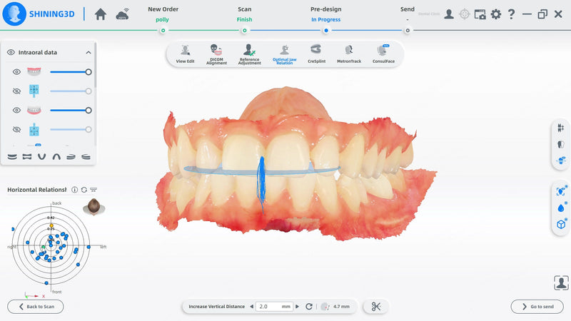 Shining3D MetiSmile – optimalaus žandikaulių santykio modulis