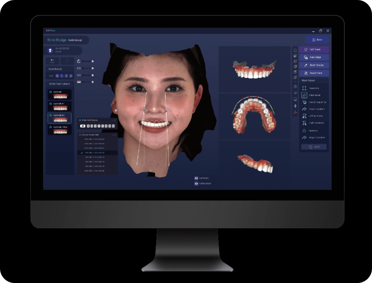 Skaitmeninis šypsenos dizainas (Digital Smile Design)