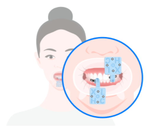 Shining 3D MetiSmile – žandikaulio judesių registravimo priedai